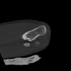SPORK, NICO - 22.03.1976 - 02.08.2022 - CT obere Extremität - 18:02:23